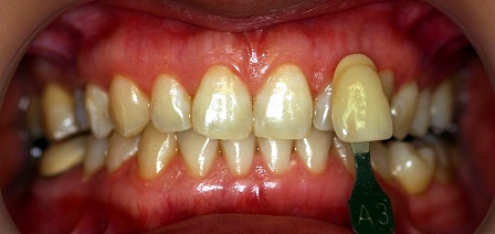 ホワイトニング